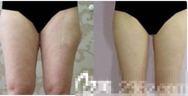 北京艾菲医疗美容腿部吸脂案例