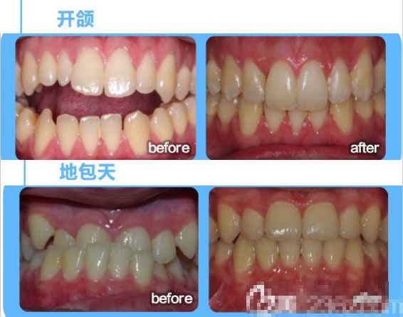 深圳诺德齿科牙齿开颌矫正及成人地包天矫正前后对比效果