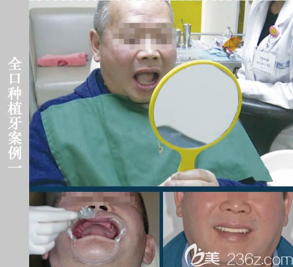 北京维乐口腔医院全口种植牙案例效果