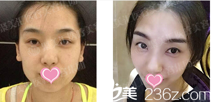 北京聚美汇医疗美容诊所注射瘦脸针案例
