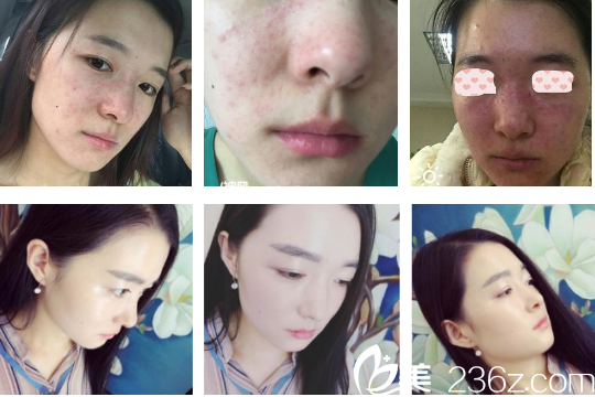 胶州市第三人民医院皮肤科激光祛痘术前术后照片