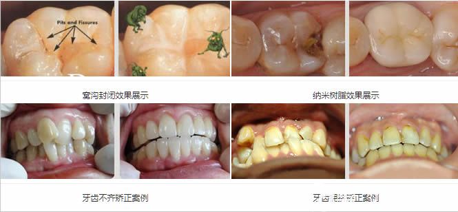 维乐口腔儿童牙齿矫正及树脂补牙前后对比照