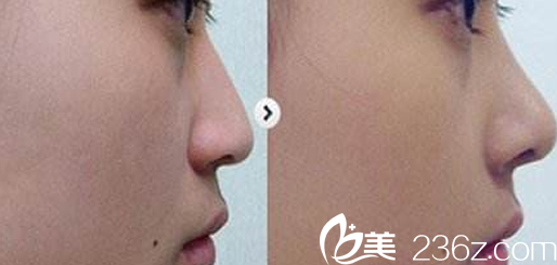 临汾雅美鼻综合隆鼻案例术前术后对比图