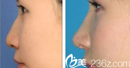 延吉李京云整形医院鼻综合整形案例对比图
