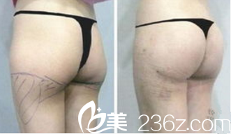 北京美联和谐医疗美容门诊脂肪丰臀案例