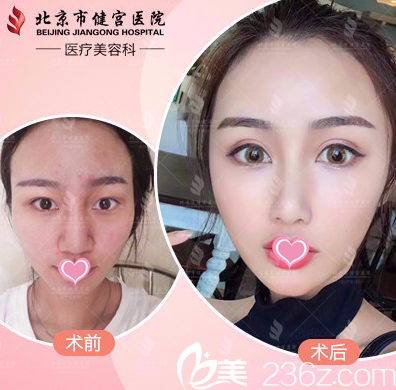 北京健宫医院医疗美容科自体脂肪面部填充案例