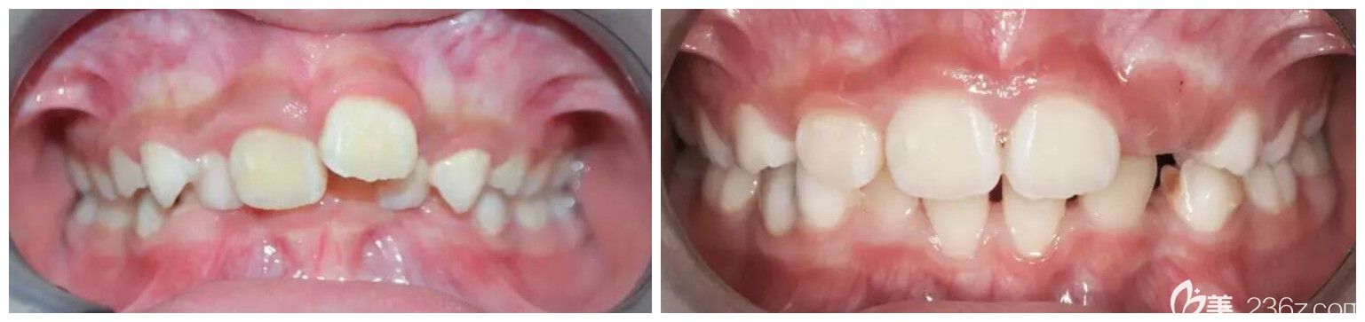 7岁小男孩替牙期牙列拥挤、前牙深覆合采用MRC矫正10个月前后效果对比