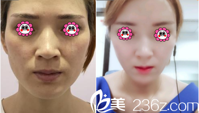 北京新美荟医疗美容医院自体脂肪面部填充案例
