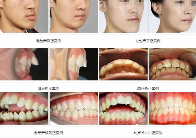 北京维乐地包天矫正和成人龅牙矫正等正畸案例效果图
