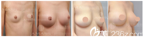 广州爱来（阿玛施）整形医院假体隆胸案例