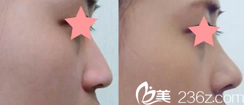 太原新世纪医疗整形鼻综合隆鼻前后效果对比图