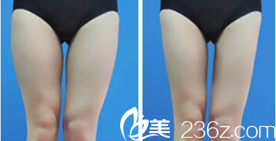 北京和谐美丽汇医疗美容腿部吸脂案例