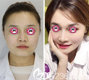 北京惠合嘉美医院自体脂肪面部填充案例