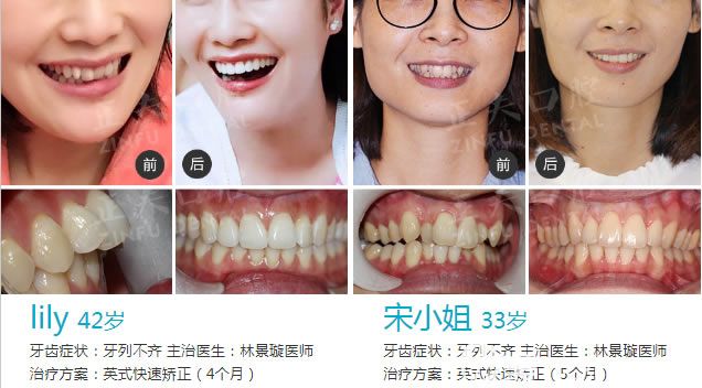 成人龅牙和牙齿不齐选择英式快速矫正前后对比效果