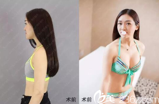 广州珈禾景丽峰自体脂肪隆胸案例
