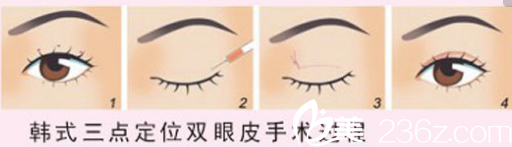 韩式双眼皮的手术过程