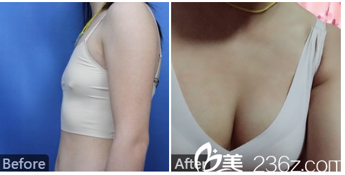 深圳和协门诊部整形美容科李宝武自体脂肪隆胸案例