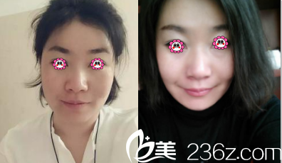 北京和谐美丽汇医疗美容面部轮廓案例