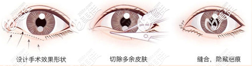 珠海九龙整形外科陈雯婷医生双眼皮手术过程