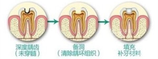 补牙流程图片