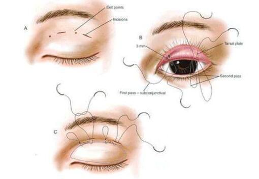 双眼皮手术方法