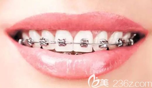 郑小燕医生尤其擅长各类牙齿矫正技术