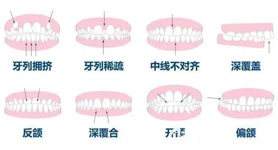 上海恒愿齿科黄晓莉医生介绍牙齿矫正适应症
