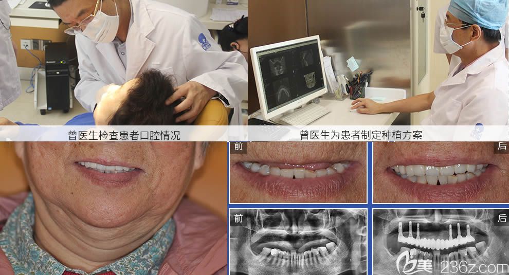 曾融生教授半口牙种植案例效果对比图