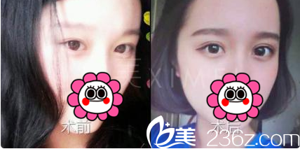 北京西美医疗美容吕薇韩式双眼皮开眼角案例
