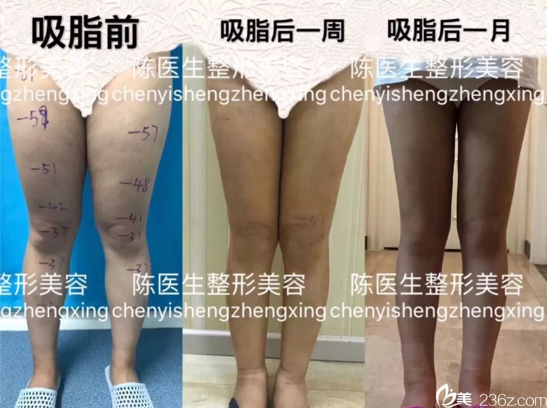 天津艺姿蔓陈昊东大腿吸脂术前术后案例效果对比图