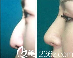 姜洪哲教授鼻部整形真人案例对比