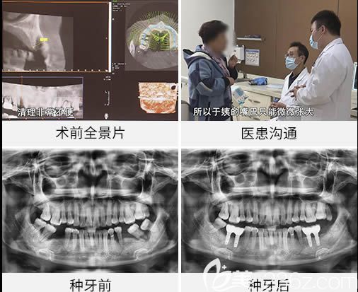 广州圣贝口腔徐浩准种植牙真人案例对比图
