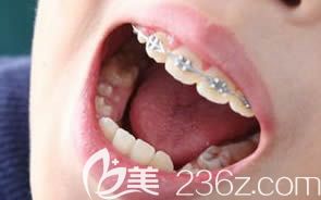 南宁洋紫荆口腔覃琨医生讲解儿童牙齿矫正的较好时机