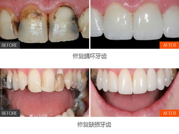 杭州薇琳马晓蓬烤瓷牙修复案例