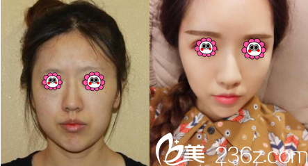 北京微美医疗美容张乃斌自体脂肪面部填充案例