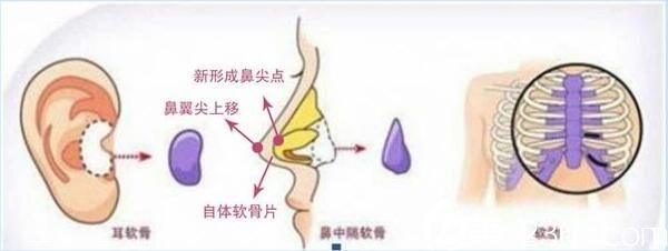 上海韩镜医疗美容医院张瑞红肋软骨隆鼻