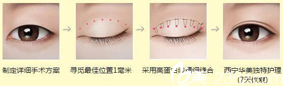 韩式双眼皮手术过程