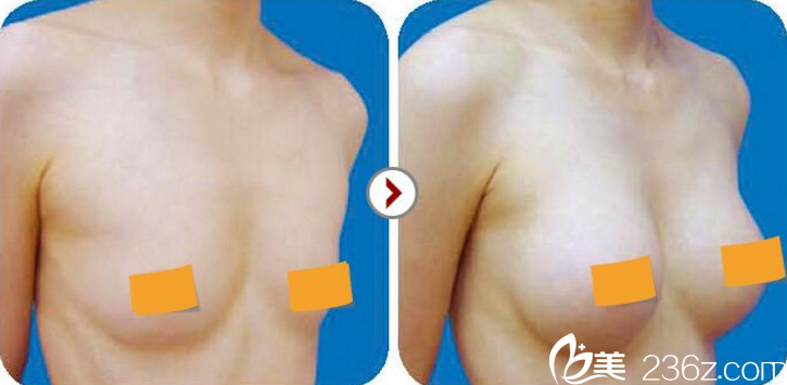 假体隆胸前后对比