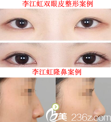 安庆市石化医院李江虹做双眼皮整形和隆鼻案例对比图