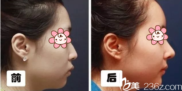 鼻整形案例2