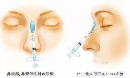 玻尿酸隆鼻方法