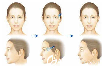 北京莫琳娜医疗美容整形医院脸部轮廓示意图