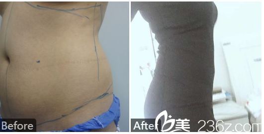 深圳雅唯医疗美容医院王权医生做的腰腹部抽脂案例