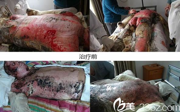 漳州175医院蔡少甫大面积烧伤治疗真实案例图
