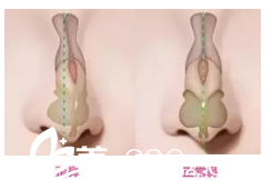 北京西美斯医疗美容诊所歪鼻和正常鼻效果图
