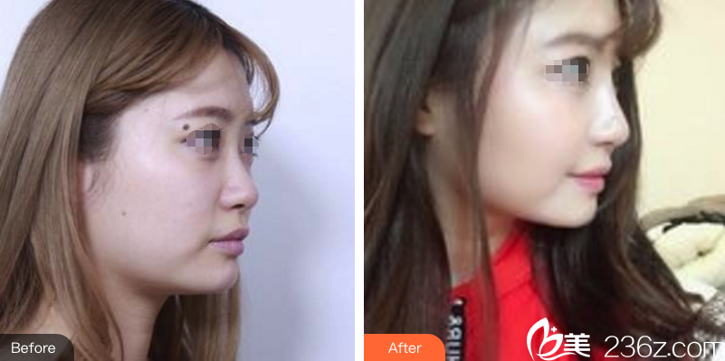 闫家峰医生玻尿酸隆鼻术前术后对比案例